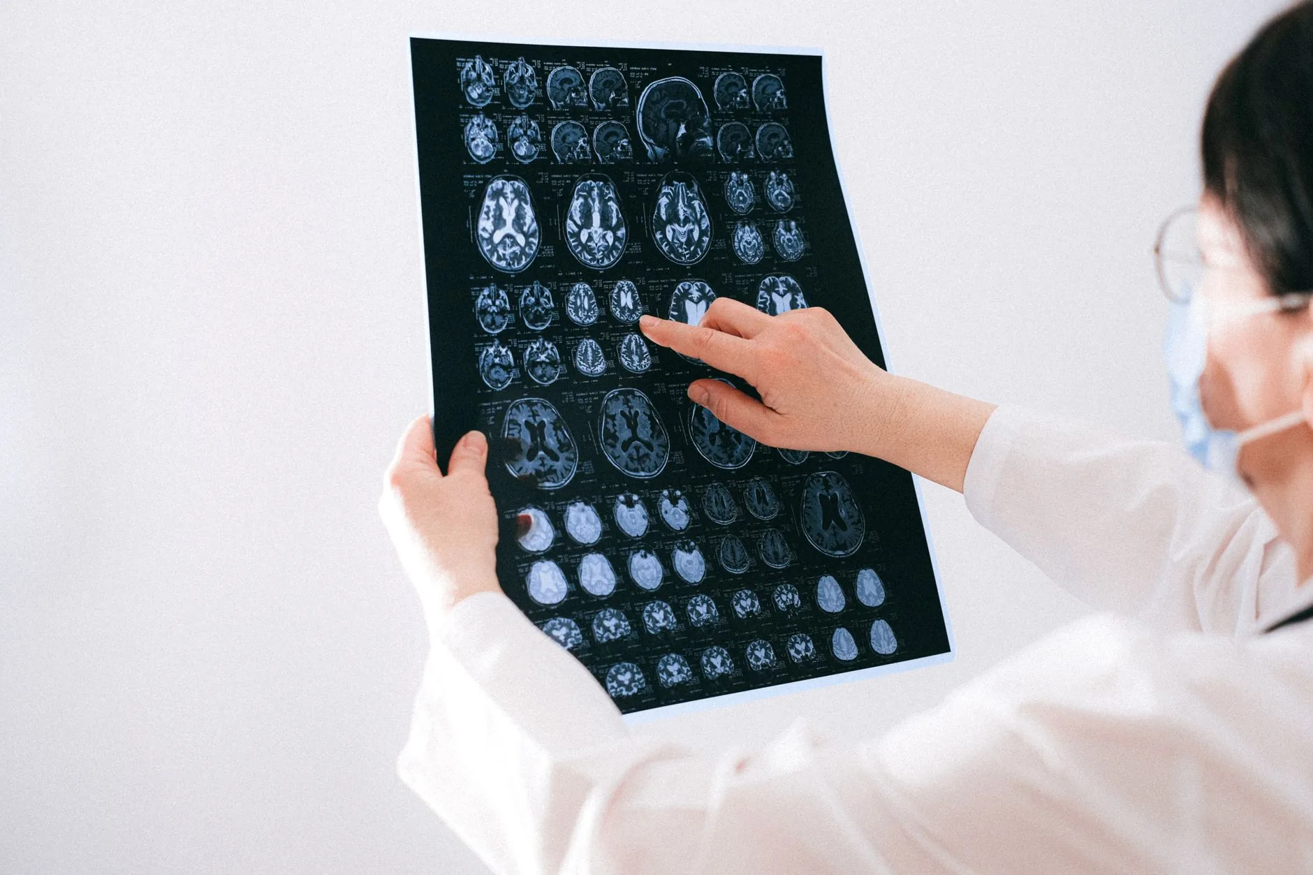 Descoberta revela como Alzheimer pode se espalhar no cérebro