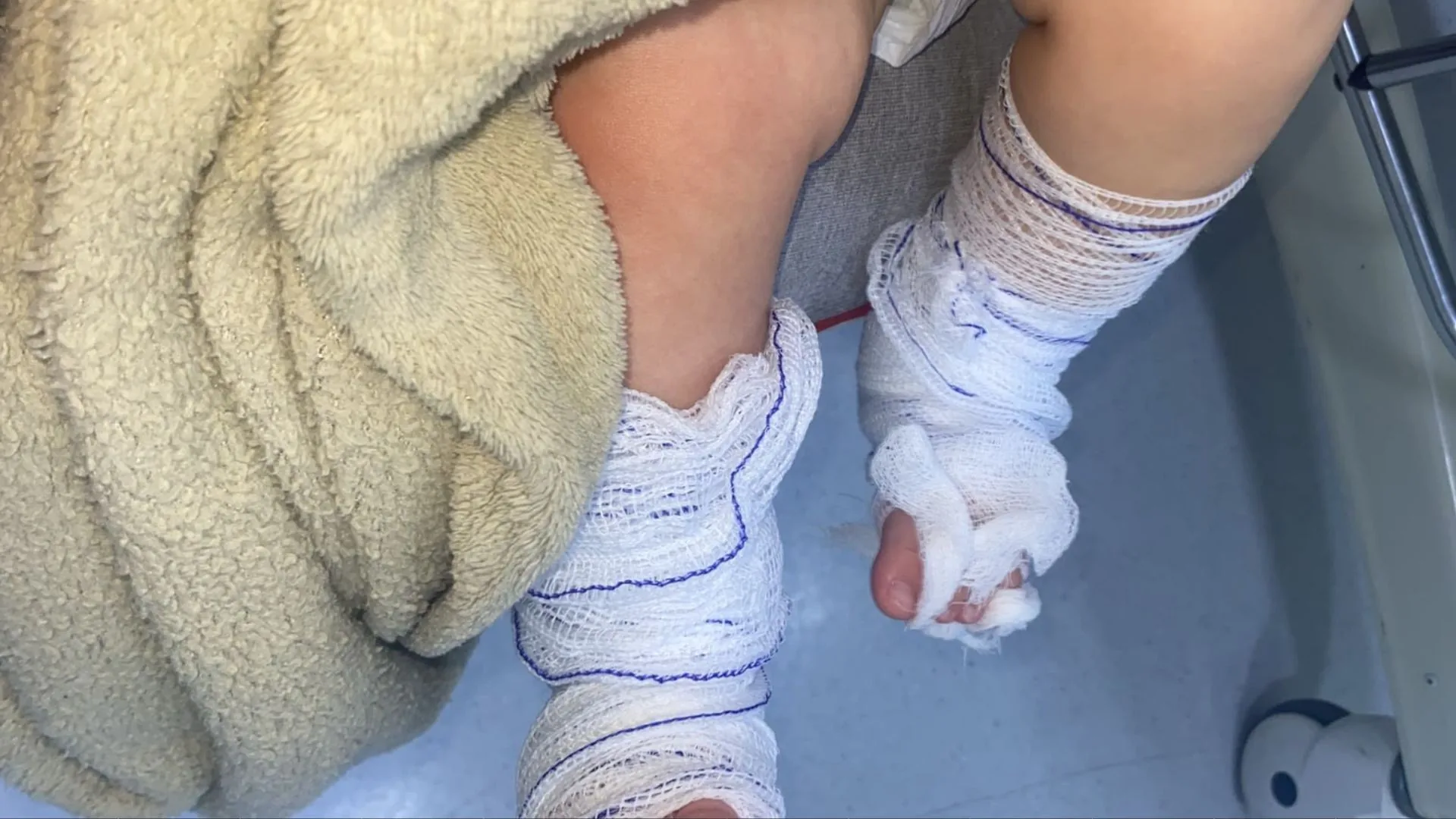 Prefeitura demite servidora após queimaduras em bebê em escola no RS