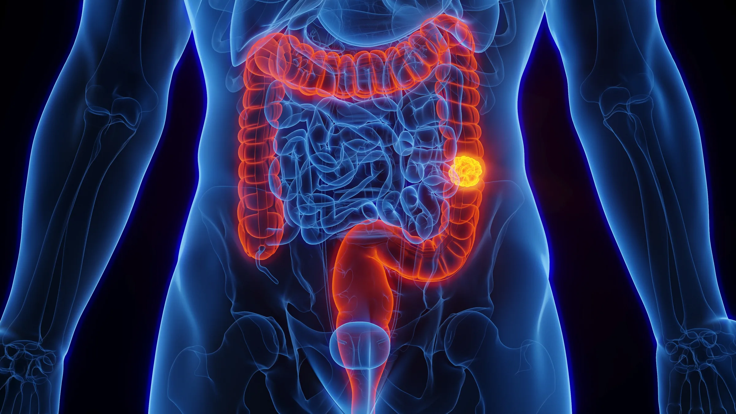 Câncer de intestino: brasileiros reconhecem sinais de alerta, mas não buscam atendimento
