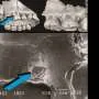 Ancient gum disease may have helped reshape jaws before human brains expanded