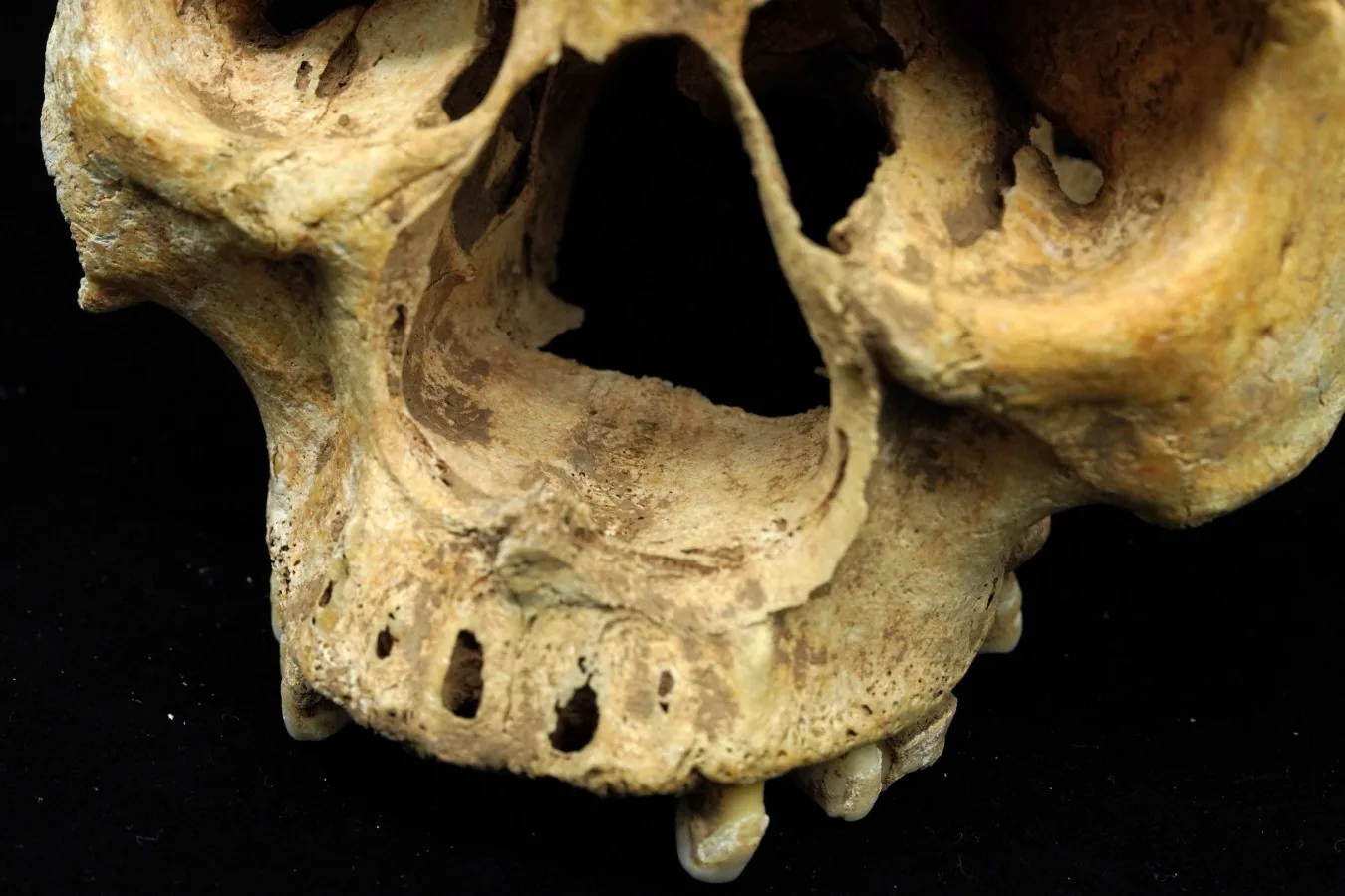 Descoberta arqueológica revela amputação nasal em mulher de China