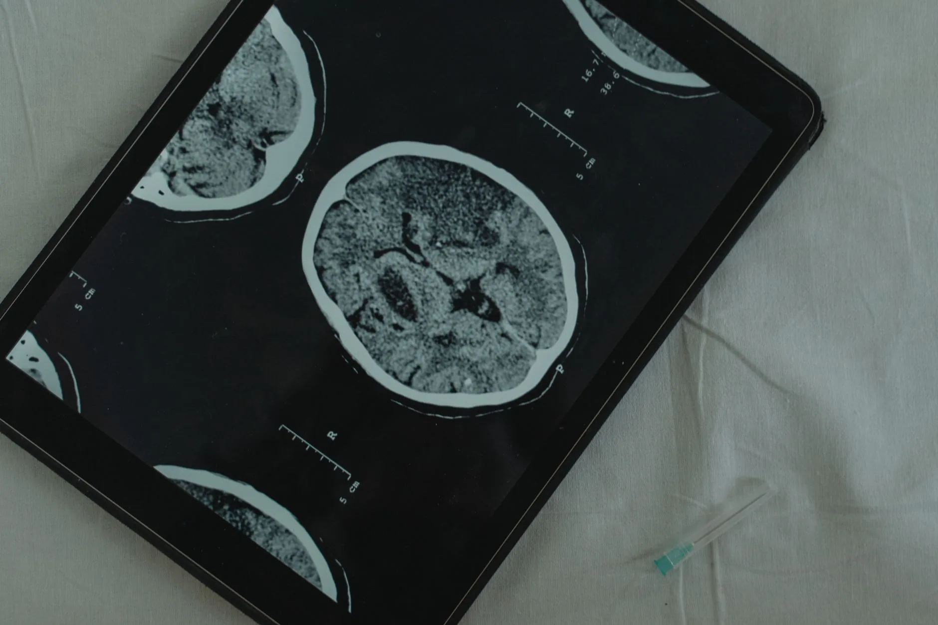 Novo implante cerebral fino pode registrar atividade neural e entregar medicamentos