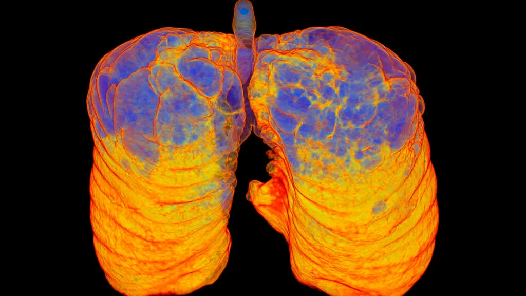AstraZeneca apresenta resultados positivos em novo tratamento contra a COPD