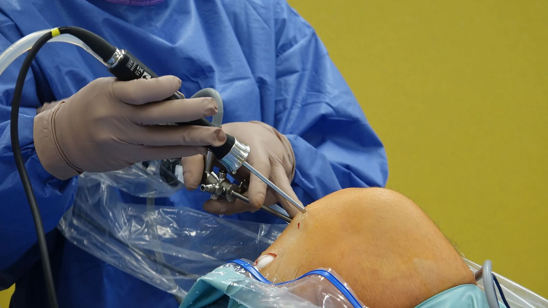 Nova técnica promete evitar cirurgia de troca de joelho