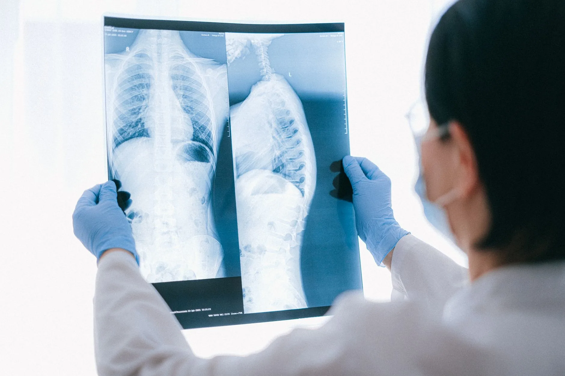 Nódulo pulmonar do Papa: possíveis causas e riscos