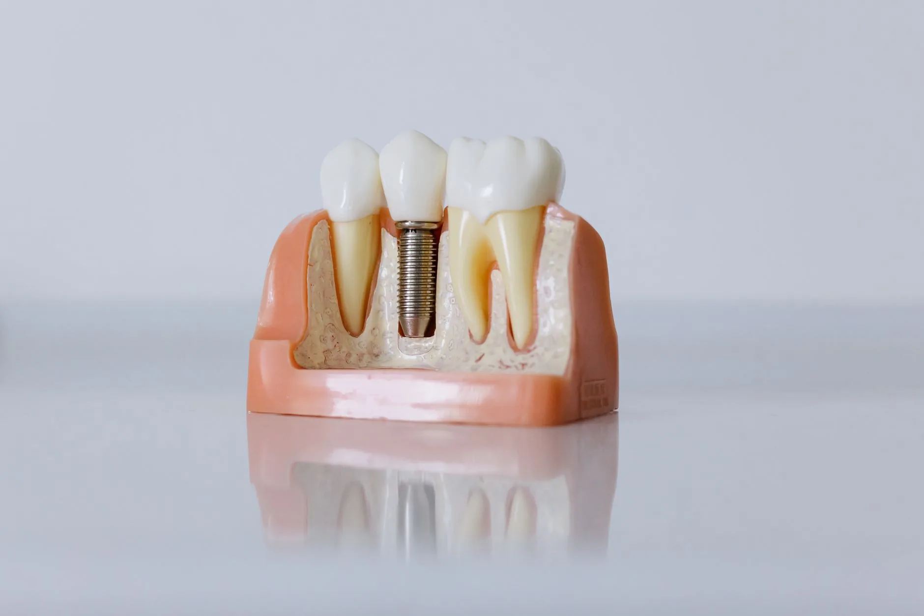 Implantes dentários podem interferir no sistema imunológico