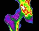 Osteoporose: risco igual para homens e mulheres