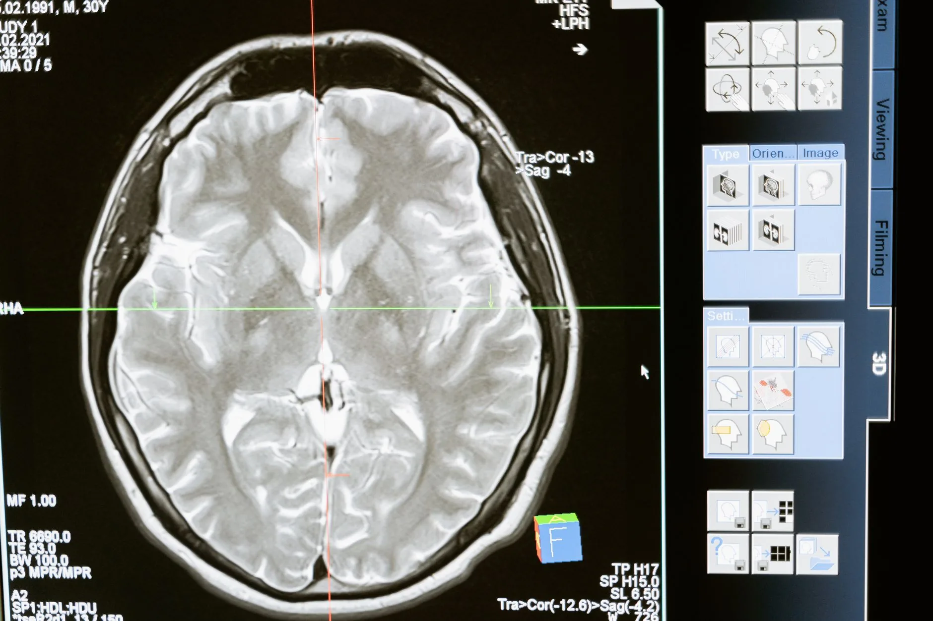 Estudo revela diferenças no processamento cerebral de rostos entre crianças autistas